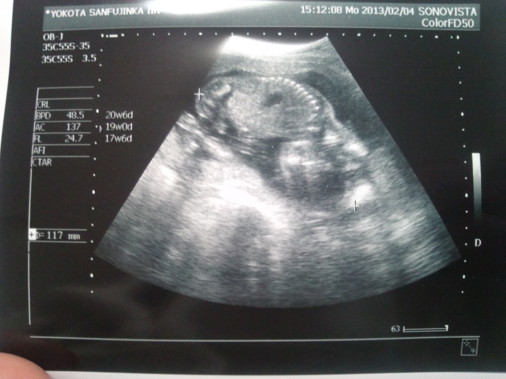 18w6d 健診 性別判明 日記 Kaonaoさんのブログ 妊娠 出産 育児に関する総合情報サイト ベビカム 18w6d 健診 性別判明 日記 Kaonaoさんのブログ 妊娠 出産 育児に関する総合情報サイト ベビカム