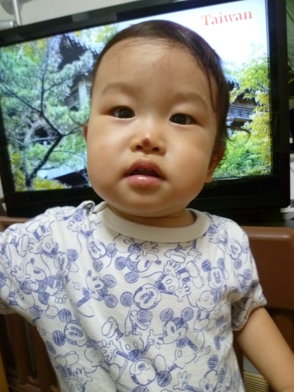 生後548日 初めて顔にキズが 日記 Chii0818さんのブログ 妊娠 出産 育児に関する総合情報サイト ベビカム