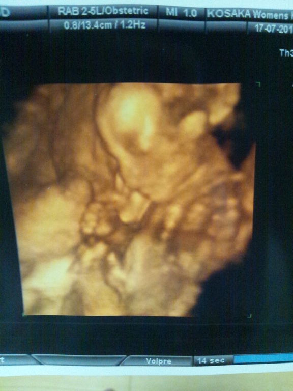 19ｗ6ｄ 性別判明 エコー写真あり 日記 こもりん2525さんのブログ 妊娠 出産 育児に関する総合情報サイト ベビカム
