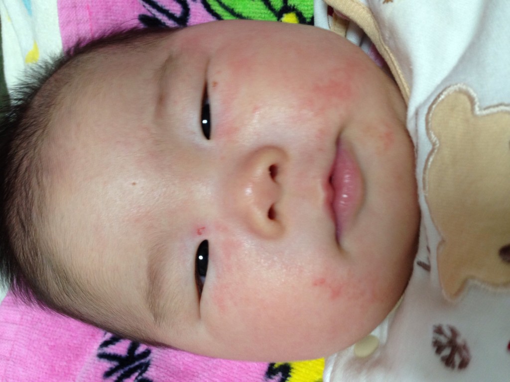 乳児湿疹 日記 カンナ715さんのブログ 妊娠 出産 育児に関する総合情報サイト ベビカム