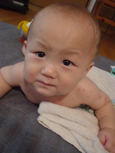 水疱瘡！｜日記｜トロぱんさんのブログ｜妊娠・出産・育児に関する総合 