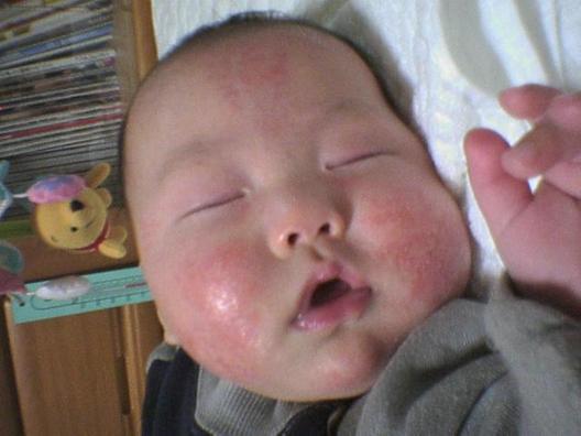 肌荒れ警報 日記 しんた さんのブログ 妊娠 出産 育児に関する総合情報サイト ベビカム 肌荒れ警報 日記 しんた さんのブログ 妊娠 出産 育児に関する総合情報サイト ベビカム