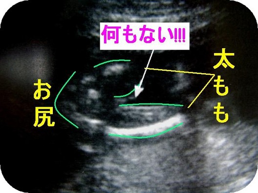 赤ちゃんは女の子なのかな 日記 るびるびさんのブログ 妊娠 出産 育児に関する総合情報サイト ベビカム 赤ちゃんは女の子なのかな 日記 るびるびさんのブログ 妊娠 出産 育児に関する総合情報サイト ベビカム